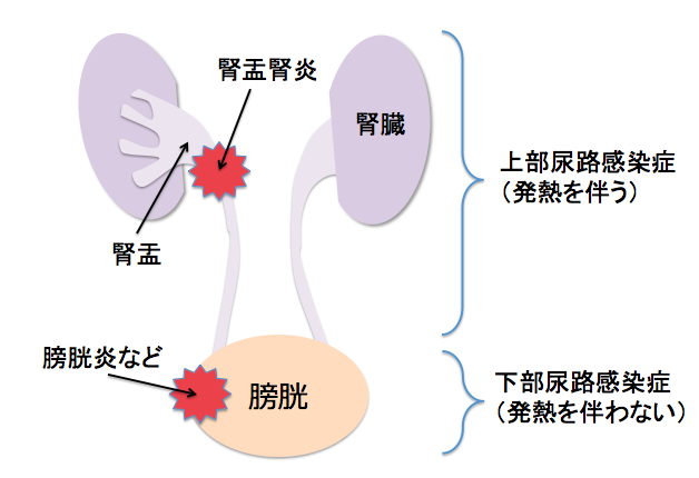 子供の尿路感染症を予防する方法
